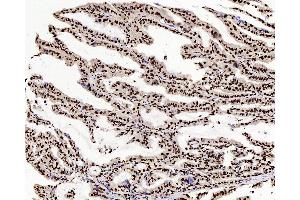 Immunohistochemistry analysis of paraffin-embedded human stomach cancer using c-Fos Polyclonal Antibody at dilution of 1:200.