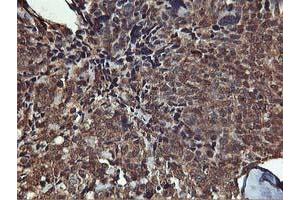 Immunohistochemical staining of paraffin-embedded Adenocarcinoma of Human breast tissue using anti-AKT1 mouse monoclonal antibody. (AKT1 anticorps)