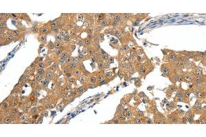 Immunohistochemistry of paraffin-embedded Human breast cancer tissue using SCN5A Polyclonal Antibody at dilution 1:30 (SCN5A anticorps)