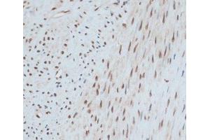 Immunohistochemistry of paraffin-embedded Human uterine cancer using ZNF433 Polyclonal Antibody at dilution of 1:100 (40x lens). (ZNF433 anticorps)