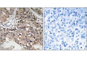 Immunohistochemistry analysis of paraffin-embedded human breast carcinoma tissue, using MAP3K7 (Ab-187) Antibody.