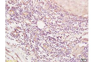 Formalin-fixed and paraffin embedded human breast carcinoma tissue labeled with Anti SGK3 Polyclonal Antibody,Unconjugated (ABIN1387590) at 1:200 followed by conjugation to the secondary antibody and DAB staining. (SGK3 anticorps  (AA 40-90))