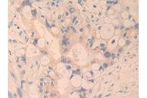 Detection of CYR61 in Human Bile duct cancer Tissue using Polyclonal Antibody to Cysteine Rich Protein, Angiogenic Inducer 61 (CYR61)