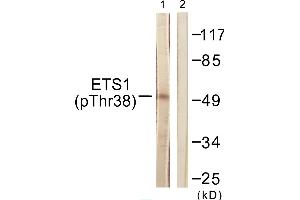 Immunohistochemistry analysis of paraffin-embedded human breast carcinoma tissue using ETS1 (Phospho-Thr38) antibody. (ETS1 anticorps  (pThr38))