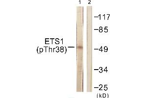 Immunohistochemistry analysis of paraffin-embedded human breast carcinoma tissue using ETS1 (Phospho-Thr38) antibody.