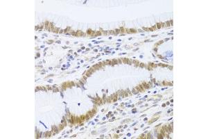 Immunohistochemistry of paraffin-embedded human gastric cancer using MCM4 Antibody (ABIN5971548) at dilution of 1/100 (40x lens). (MCM4 anticorps)