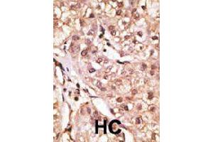 Formalin-fixed and paraffin-embedded human hepatocellular carcinoma tissue reacted with IL29 polyclonal antibody  , which was peroxidase-conjugated to the secondary antibody, followed by DAB staining. (IL29 anticorps  (Internal Region))