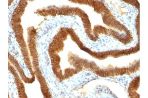 Formalin-fixed, paraffin-embedded human Colon Carcinoma stained with Ep-CAM Mouse Monoclonal Antibody (VU-1D9). (EpCAM anticorps)
