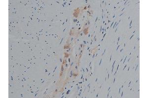 ABIN6267420 at 1/50 staining human colon carcinoma tissue sections by IHC-P. (Phospholipase C gamma 1 anticorps  (pTyr771))
