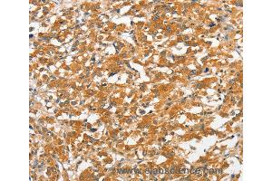 Immunohistochemistry of Human gastric cancer using ANKMY2 Polyclonal Antibody at dilution of 1:30 (ANKMY2 anticorps)