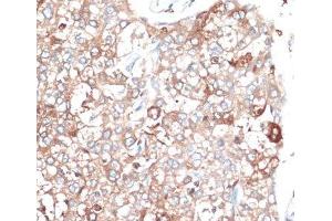 Immunohistochemistry of paraffin-embedded Human liver cancer using SLAMF7 Polyclonal Antibody at dilution of 1:100 (40x lens). (SLAMF7 anticorps)