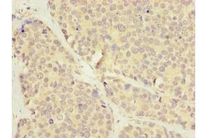 Immunohistochemistry of paraffin-embedded human gastric cancer using ABIN7175622 at dilution of 1:100