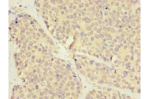 Immunohistochemistry of paraffin-embedded human gastric cancer using ABIN7175622 at dilution of 1:100 (LRRC8E anticorps  (AA 353-630))