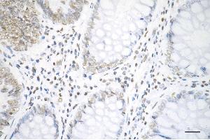 Immunohistochemistry was performed on paraffin-embedded human sigmoid colon carcinoma using histone H3 (acetyl K19) antibody (ABIN7798970), 1:200).