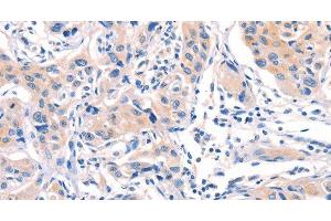 Immunohistochemistry of paraffin-embedded Human lung cancer tissue using AFDN Polyclonal Antibody at dilution 1:40 (Afadin anticorps)