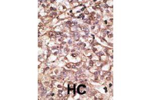 Formalin-fixed and paraffin-embedded human hepatocellular carcinoma tissue reacted with DKK4 polyclonal antibody  , which was peroxidase-conjugated to the secondary antibody, followed by DAB staining. (DKK4 anticorps  (C-Term))