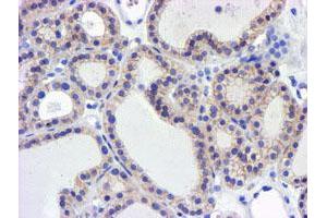 Immunohistochemical staining of paraffin-embedded Carcinoma of Human thyroid tissue using anti-GSTO2 mouse monoclonal antibody. (GSTO2 anticorps)