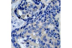 Immunohistochemistry of paraffin-embedded human breast carcinoma using Phospho-PTK2B-Y402 antibody (ABIN2987623). (PTK2B anticorps  (pTyr402))