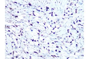 Immunohistochemistry of paraffin-embedded human oophoroma using HMG Rabbit mAb (ABIN7267646) at dilution of 1:100 (40x lens). (HMGA1 anticorps)