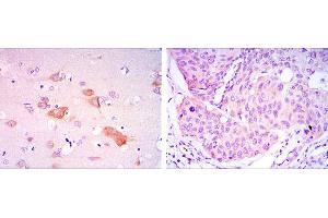 Immunohistochemical analysis of paraffin-embedded brain tissues (left) and lung cancer tissues (right) using SMAD5 mouse mAb with DAB staining.