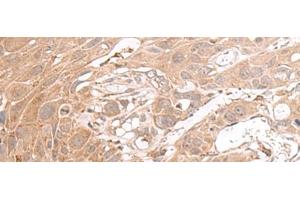 Immunohistochemistry of paraffin-embedded Human esophagus cancer tissue using CHST4 Polyclonal Antibody at dilution of 1:35(x200) (CHST4 anticorps)