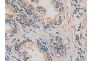 Detection of CACYBP in Human Prostate Tissue using Polyclonal Antibody to Calcyclin Binding Protein (CACYBP)