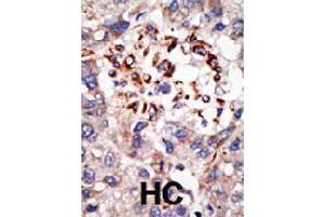 Formalin-fixed and paraffin-embedded human hepatocellular carcinoma tissue reacted with CBX8 polyclonal antibody  , which was peroxidase-conjugated to the secondary antibody, followed by DAB staining . (CBX8 anticorps  (C-Term))