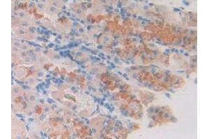 IHC-P analysis of Human Stomach Cancer Tissue, with DAB staining. (SLIT1 anticorps  (AA 647-835))