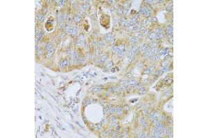 Immunohistochemistry of paraffin-embedded human colon carcinoma using PSG1 antibody. (PSG1 anticorps  (AA 180-419))
