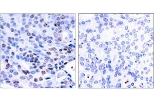 Immunohistochemistry analysis of paraffin-embedded human breast carcinoma tissue, using NF-kappaB p105/p50 (Ab-337) Antibody. (NFKB1 anticorps  (AA 304-353))