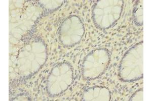 Immunohistochemistry of paraffin-embedded human colon cancer using ABIN7155121 at dilution of 1:100