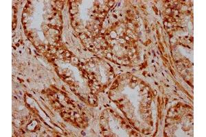 IHC image of ABIN7155735 diluted at 1:600 and staining in paraffin-embedded human prostate cancer performed on a Leica BondTM system. (HOXB3 anticorps  (AA 315-423))