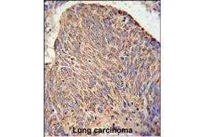 C Antibody (Center) (ABIN650934 and ABIN2840000) IHC analysis in formalin fixed and paraffin embedded human lung carcinoma followed by peroxidase conjugation of the secondary antibody and DAB staining.