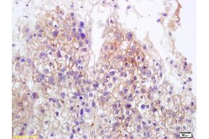 Formalin-fixed and paraffin embedded human lung carcinoma labeled with Anti-MICB Polyclonal Antibody, Unconjugated (ABIN1385296) at 1:200 followed by conjugation to the secondary antibody and DAB staining. (MICA/B anticorps  (AA 81-180))