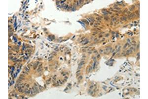 The image on the left is immunohistochemistry of paraffin-embedded Human colon cancer tissue using ABIN7190314(CMTM7 Antibody) at dilution 1/30, on the right is treated with synthetic peptide. (CMTM7 anticorps)