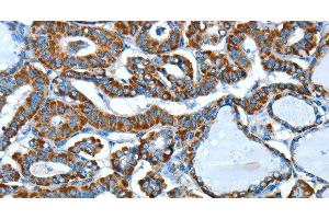 Immunohistochemistry of paraffin-embedded Human thyroid cancer using ALDH6A1 Polyclonal Antibody at dilution of 1:45 (ALDH6A1 anticorps)