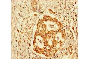Immunohistochemistry of paraffin-embedded human pancreatic cancer using ABIN7153335 at dilution of 1:100