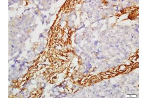 Formalin-fixed and paraffin embedded human lung carcinoma labeled with Anti-SLC7A5 Polyclonal Antibody, Unconjugated  at 1:200 followed by conjugation to the secondary antibody and DAB staining (SLC7A5 anticorps  (AA 101-200))