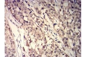 Immunohistochemical analysis of paraffin-embedded cervical cancer tissues using GSTP1 mouse mAb with DAB staining.