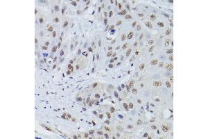 Immunohistochemistry of paraffin-embedded human esophageal cancer using MRE11 Rabbit pAb (ABIN3016249, ABIN3016250, ABIN3016251 and ABIN6219660) at dilution of 1:50 (40x lens).