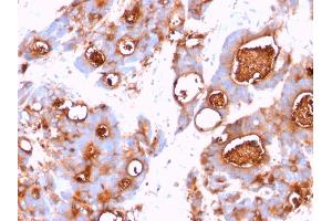 Formalin-fixed, paraffin-embedded human Colon Carcinoma stained with CEA Mouse Monoclonal Antibody (CEA31). (CEACAM5 anticorps)