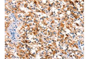 The image on the left is immunohistochemistry of paraffin-embedded Human thyroid cancer tissue using ABIN7192636(SPRN Antibody) at dilution 1/15, on the right is treated with synthetic peptide. (SPRN anticorps)