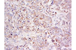 Formalin-fixed and paraffin embedded human lung carcinoma labeled with Anti-LDLRAD3 Polyclonal Antibody, Unconjugated  at 1:500 followed by conjugation to the secondary antibody and DAB staining (LDLRAD3 anticorps  (AA 101-200))
