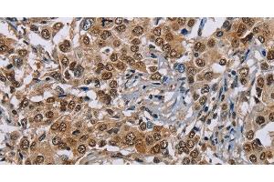 Immunohistochemistry of paraffin-embedded Human liver cancer using GTF2I Polyclonal Antibody at dilution of 1:40 (GTF2I anticorps)