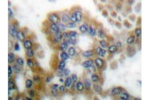 Immunohistochemistry analyzes of CrkL antibody in paraffin-embedded human lung carcinoma tissue. (CrkL anticorps)