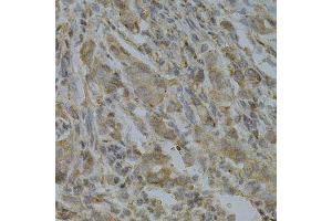 Immunohistochemistry of paraffin-embedded human gastric cancer using GGA2 Antibody.