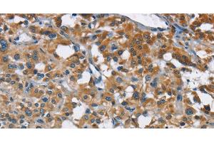 Immunohistochemistry of paraffin-embedded Human thyroid cancer tissue using ANKHD1 Polyclonal Antibody at dilution 1:40