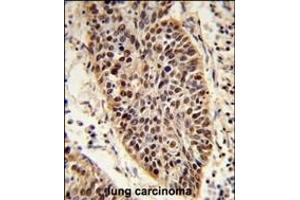 Formalin-fixed and raffin-embedded human lung carcinoma reacted with X Antibody (C-term), which was peroxidase-conjugated to the secondary antibody, followed by DAB staining.