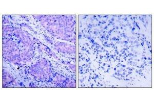 Immunohistochemical analysis of paraffin-embedded human breast carcinoma tissue using PDK1(Phospho-Ser241) Antibody(left) or the same antibody preincubated with blocking peptide(right). (PDPK1 anticorps  (pSer241))