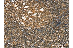 The image on the left is immunohistochemistry of paraffin-embedded Human tonsil tissue using ABIN7192667(STAB1 Antibody) at dilution 1/20, on the right is treated with synthetic peptide. (Stabilin 1 anticorps)